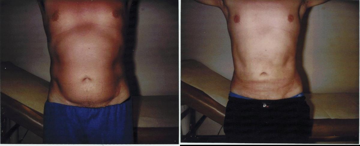 32+ Bruststraffung vorher nachher bilder , Jacques Zufferey Bauchstraffung (Abdominoplastik) Vorher / Nachher
